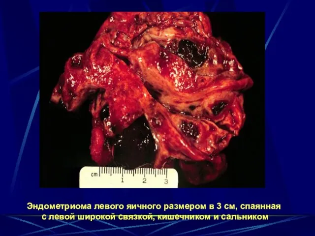 Эндометриома левого яичного размером в 3 см, спаянная с левой широкой связкой, кишечником и сальником