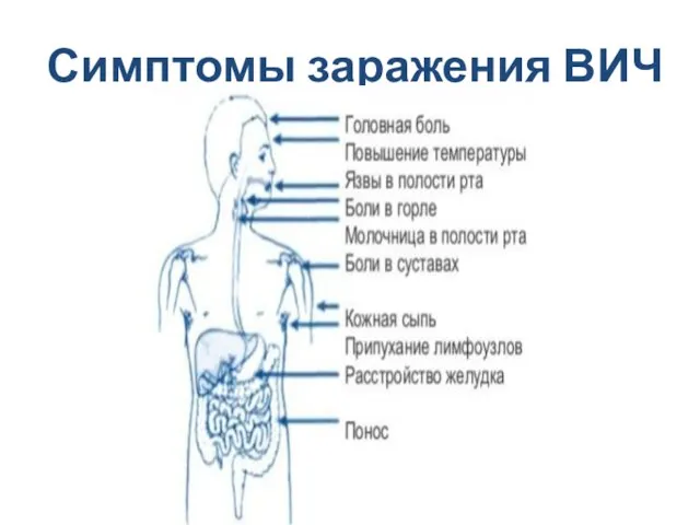 Симптомы заражения ВИЧ