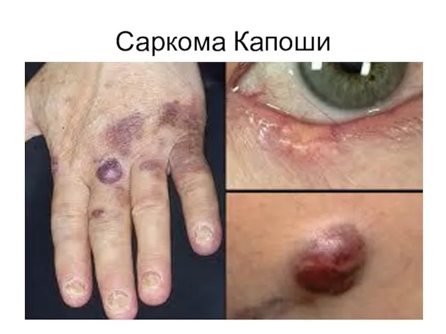 Саркома Капоши