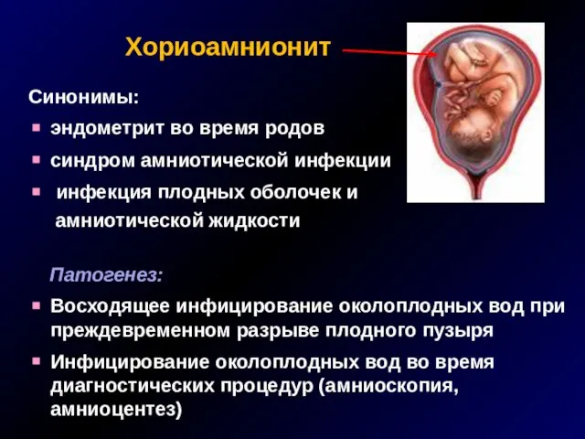 Хориоамнионит Синонимы: эндометрит во время родов синдром амниотической инфекции инфекция плодных оболочек