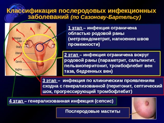 Классификация послеродовых инфекционных заболеваний (по Сазонову-Бартельсу) 1 этап – инфекция ограничена областью