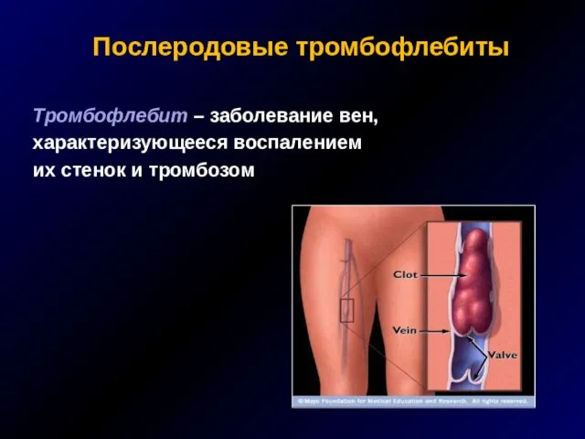 Послеродовые тромбофлебиты Тромбофлебит – заболевание вен, характеризующееся воспалением их стенок и тромбозом