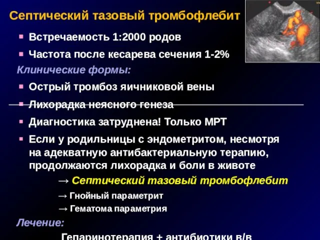 Септический тазовый тромбофлебит Встречаемость 1:2000 родов Частота после кесарева сечения 1-2% Клинические