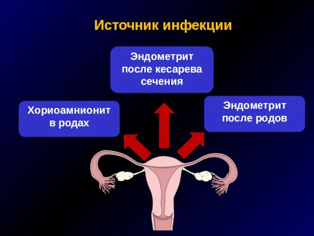 Источник инфекции Хориоамнионит в родах Эндометрит после кесарева сечения Эндометрит после родов