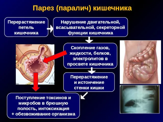 Парез (паралич) кишечника Скопление газов, жидкости, белков, электролитов в просвете кишечника Поступление