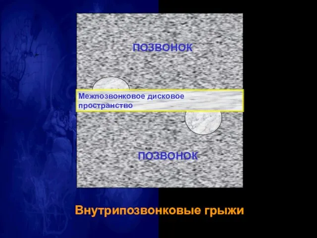 Внутрипозвонковые грыжи Межпозвонковое дисковое пространство ПОЗВОНОК ПОЗВОНОК