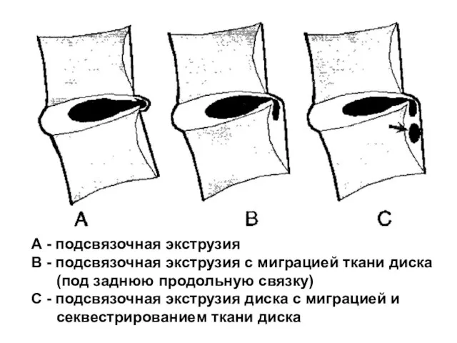 А - подсвязочная экструзия В - подсвязочная экструзия с миграцией ткани диска