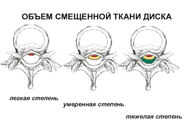 ОБЪЕМ СМЕЩЕННОЙ ТКАНИ ДИСКА легкая степень умеренная степень тяжелая степень