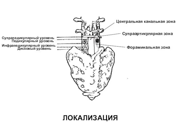 Центральная канальная зона Супраартикулярная зона Фораминальная зона Супрапедикулярный уровень Педикулярный уровень Инфрапедикулярный уровень Дисковый уровень ЛОКАЛИЗАЦИЯ