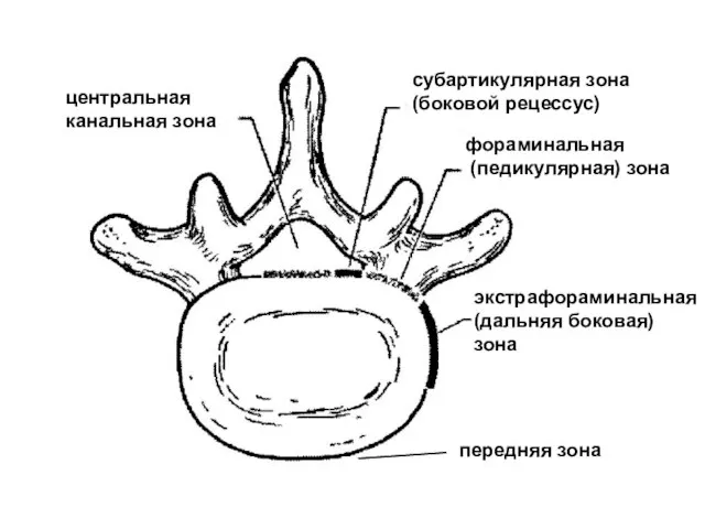 центральная канальная зона субартикулярная зона (боковой рецессус) фораминальная (педикулярная) зона экстрафораминальная (дальняя боковая) зона передняя зона