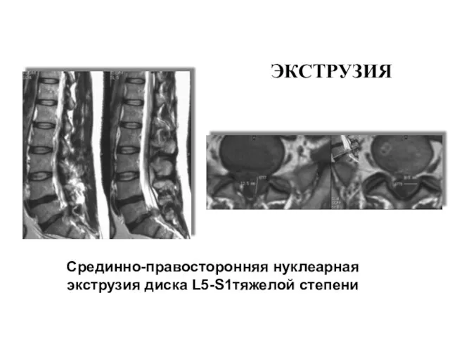 ЭКСТРУЗИЯ Срединно-правосторонняя нуклеарная экструзия диска L5-S1тяжелой степени