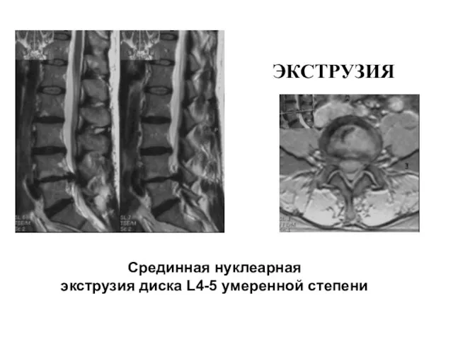 ЭКСТРУЗИЯ Срединная нуклеарная экструзия диска L4-5 умеренной степени