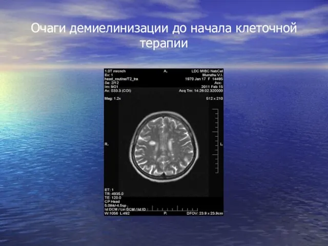 Очаги демиелинизации до начала клеточной терапии