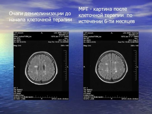 Очаги демиелинизации до начала клеточной терапии МРТ - картина после клеточной терапии по истечении 6-ти месяцев
