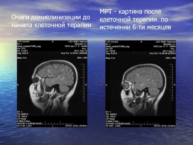 Очаги демиелинизации до начала клеточной терапии МРТ - картина после клеточной терапии по истечении 6-ти месяцев