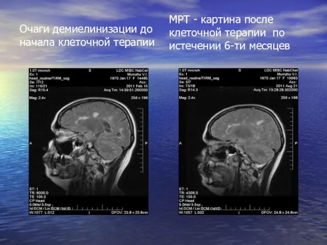 Очаги демиелинизации до начала клеточной терапии МРТ - картина после клеточной терапии по истечении 6-ти месяцев