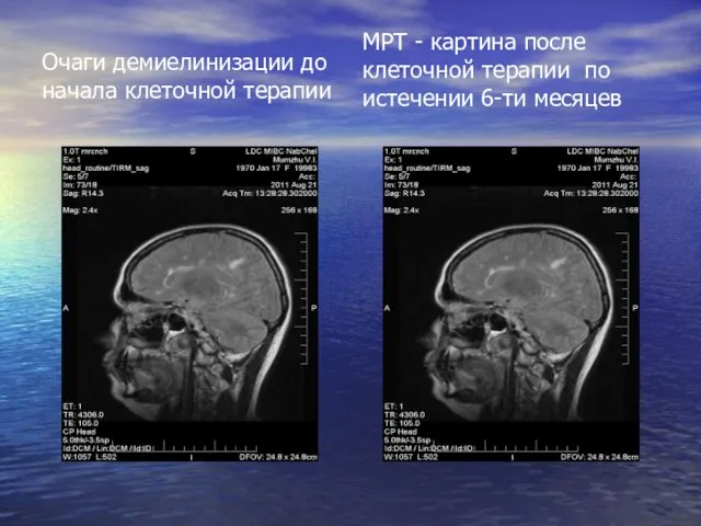 Очаги демиелинизации до начала клеточной терапии МРТ - картина после клеточной терапии по истечении 6-ти месяцев