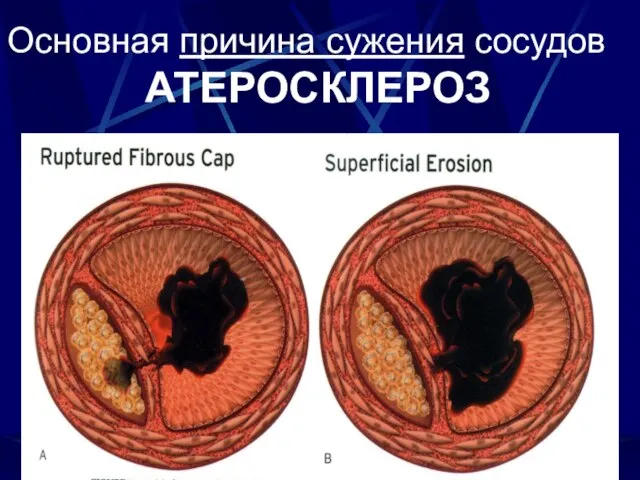 Основная причина сужения сосудов АТЕРОСКЛЕРОЗ