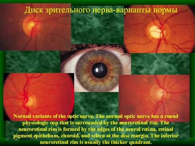 Normal variants of the optic nerve. The normal optic nerve has a