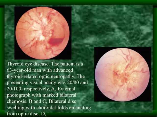 Thyroid eye disease. The patient is a 63-year-old man with advanced thyroid-related