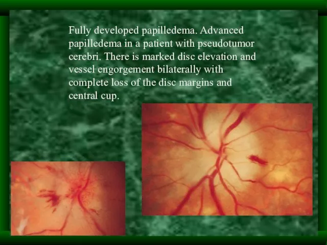 Fully developed papilledema. Advanced papilledema in a patient with pseudotumor cerebri. There