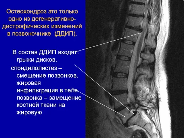 Остеохондроз это только одно из дегенеративно-дистрофических изменений в позвоночнике (ДДИП). В состав