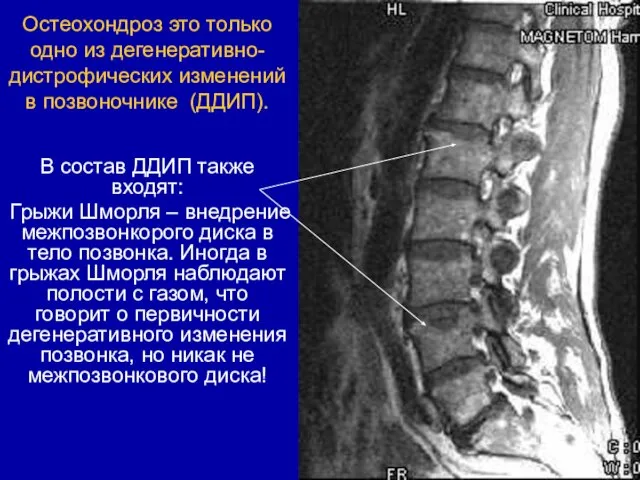 Остеохондроз это только одно из дегенеративно-дистрофических изменений в позвоночнике (ДДИП). В состав