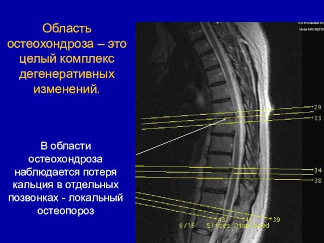 Область остеохондроза – это целый комплекс дегенеративных изменений. В области остеохондроза наблюдается