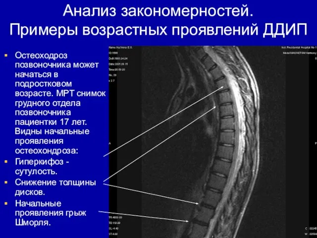 Анализ закономерностей. Примеры возрастных проявлений ДДИП Остеоходроз позвоночника может начаться в подростковом