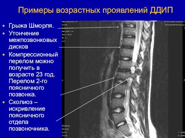 Примеры возрастных проявлений ДДИП Грыжа Шморля. Утончение межпозвонковых дисков Компрессионный перелом можно