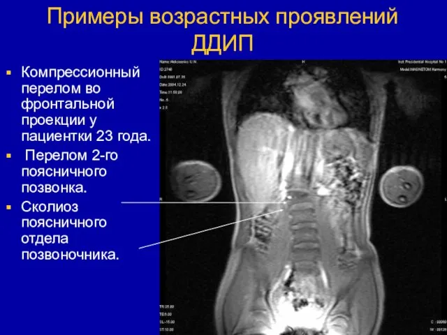 Примеры возрастных проявлений ДДИП Компрессионный перелом во фронтальной проекции у пациентки 23