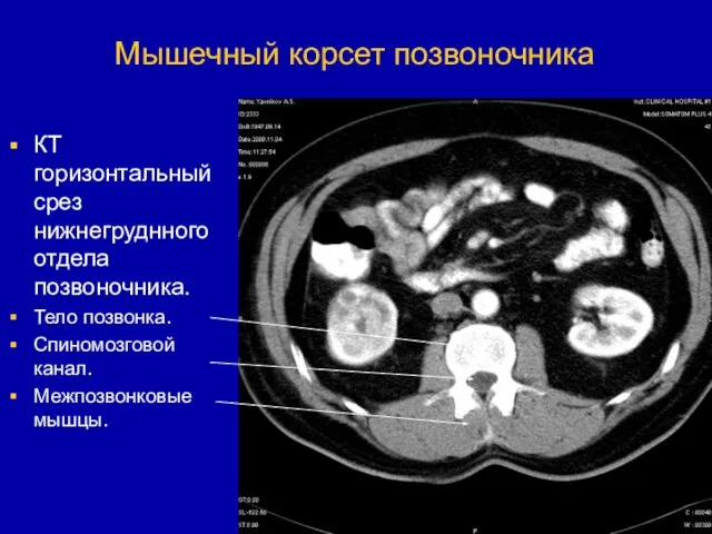 Мышечный корсет позвоночника КТ горизонтальный срез нижнегруднного отдела позвоночника. Тело позвонка. Спиномозговой канал. Межпозвонковые мышцы.