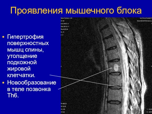 Проявления мышечного блока Гипертрофия поверхностных мышц спины, утолщение подкожной жировой клетчатки. Новообразование в теле позвонка Th6.