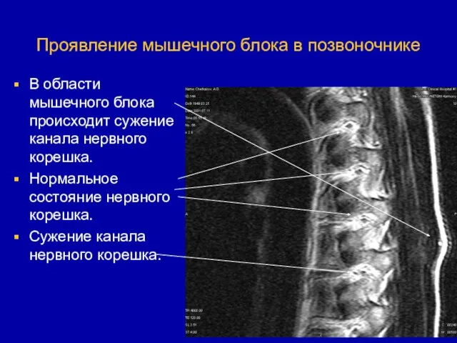 Проявление мышечного блока в позвоночнике В области мышечного блока происходит сужение канала