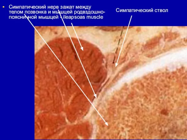 Симпатический ствол Симпатический нерв зажат между телом позвонка и мышцей родвздошно-поясничной мышцей - ileapsoas muscle
