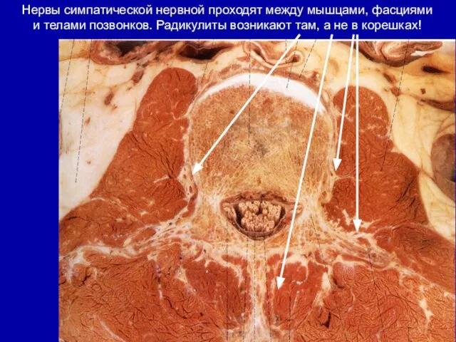 Нервы симпатической нервной проходят между мышцами, фасциями и телами позвонков. Радикулиты возникают