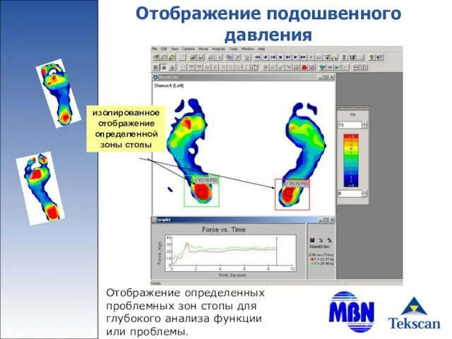 Отображение подошвенного давления Отображение определенных проблемных зон стопы для глубокого анализа функции