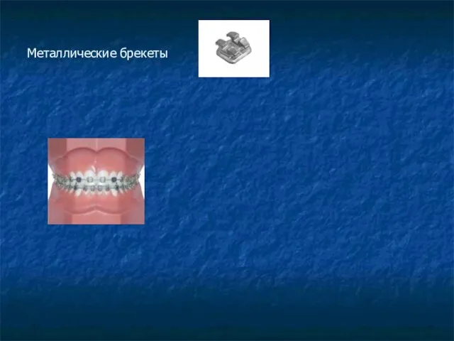 Металлические брекеты