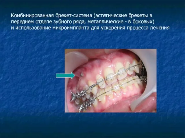 Комбинированная брекет-система (эстетические брекеты в переднем отделе зубного ряда, металлические - в