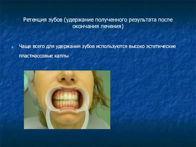 Ретенция зубов (удержание полученного результата после окончания лечения) Чаще всего для удержания