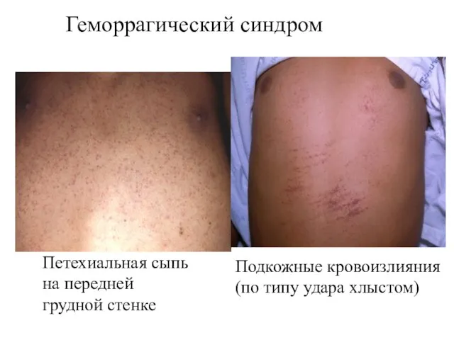 Петехиальная сыпь на передней грудной стенке Подкожные кровоизлияния (по типу удара хлыстом) Геморрагический синдром