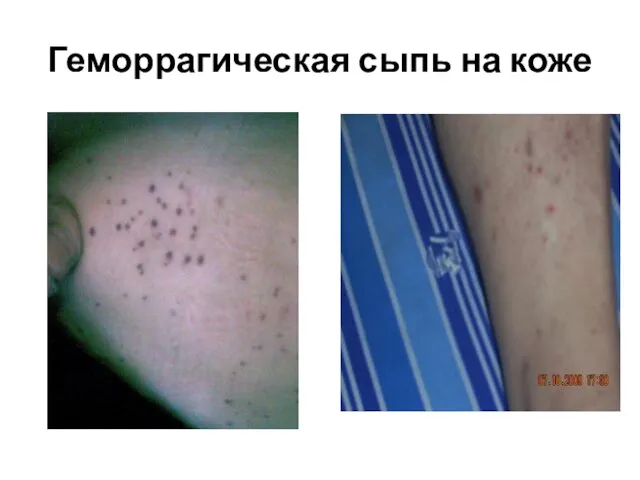 Геморрагическая сыпь на коже