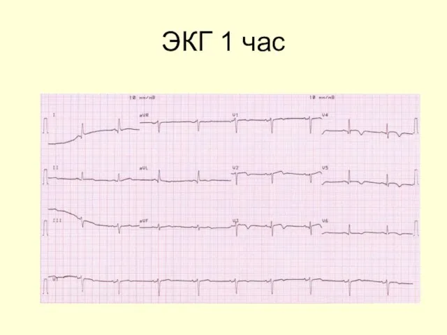 ЭКГ 1 час