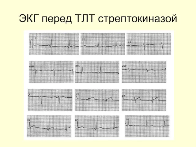 ЭКГ перед ТЛТ стрептокиназой