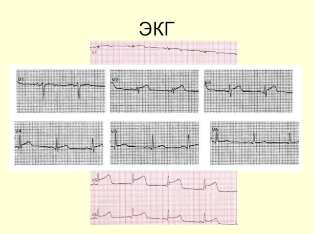 ЭКГ