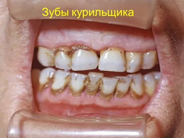 Зубы курильщика