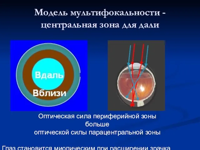 Модель мультифокальности - центральная зона для дали Оптическая сила периферийной зоны больше