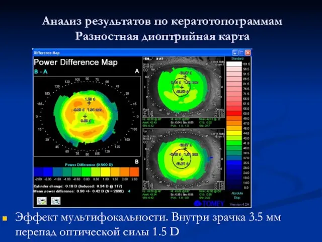 Анализ результатов по кератотопограммам Разностная диоптрийная карта Эффект мультифокальности. Внутри зрачка 3.5