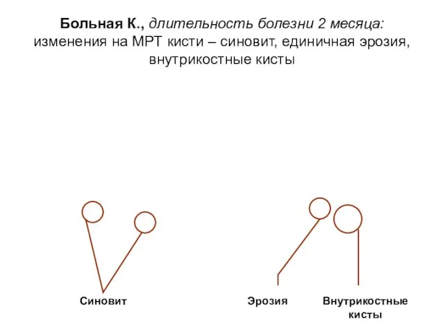 Синовит Эрозия Внутрикостные кисты Больная К., длительность болезни 2 месяца: изменения на