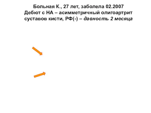 Больная К., 27 лет, заболела 02.2007 Дебют с НА – асимметричный олигоартрит